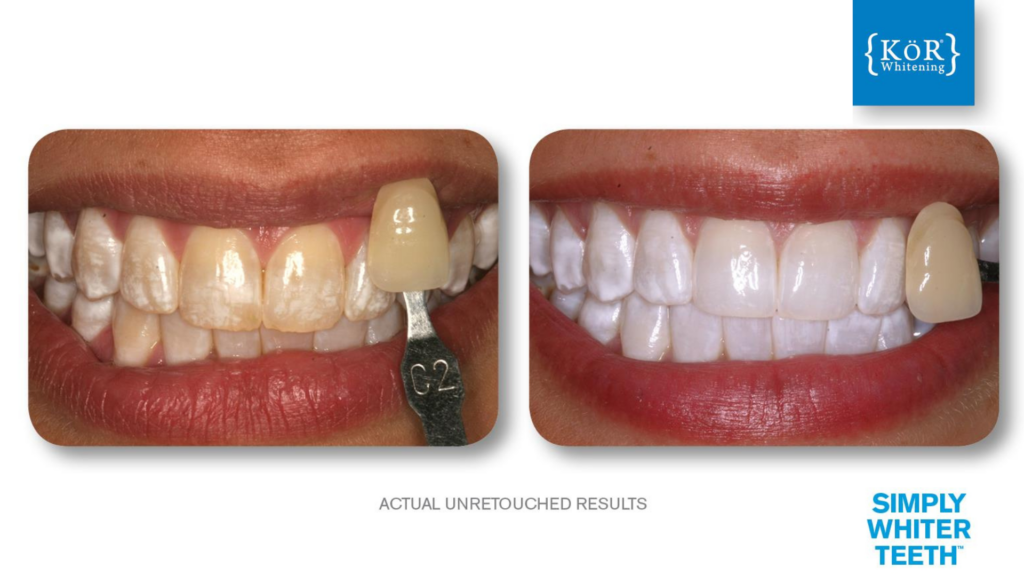 Before and after images of teeth whitening. Left shows yellowish teeth with a shade guide; right shows visibly whiter, brighter teeth.