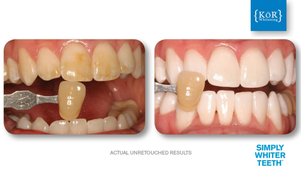 Before-and-after image of teeth whitening. Left shows yellowed teeth, right shows bright white teeth with a shade guide. Text reads: "Actual Unretouched Results."