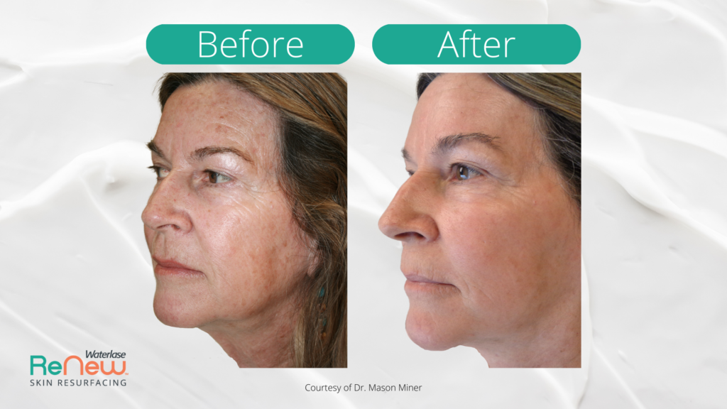 Two side-by-side profile photos of a woman's face labeled "Before" and "After," showing smoother skin texture in the "After" image, with a neutral background.