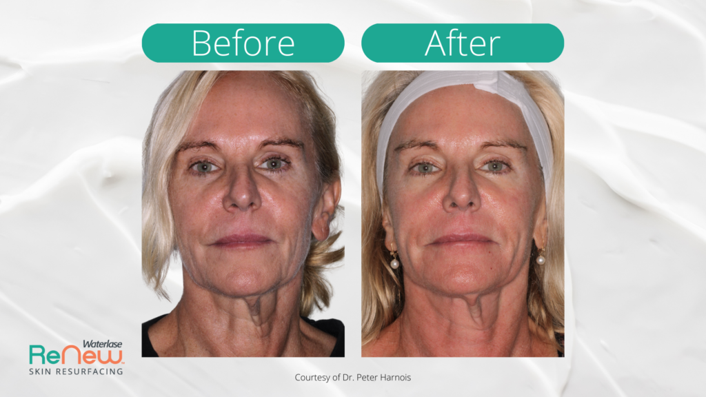 Before and after comparison of a woman's face showing skin improvements post-resurfacing treatment; left side has duller skin, right side is smoother.