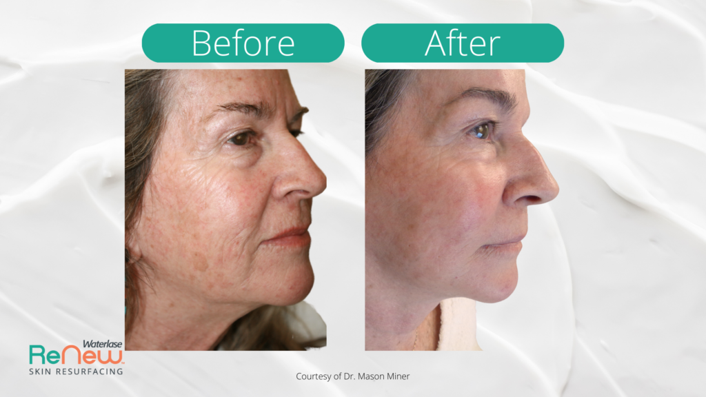 Before and after images of a woman's profile show reduced wrinkles and smoother skin post-skin resurfacing. The tone is calm and rejuvenated.