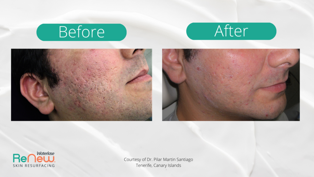 Before and after images of a man's cheek showing improved skin texture post-treatment. The left side shows acne scars; the right side appears smoother.