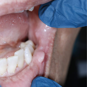 Close-up of a dental examination. Gloved hand holding mouth open, showing lower teeth and gum with a swollen area, creating a clinical tone.
