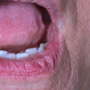 Close-up of a person's open mouth showing the lower teeth, inner lip, and part of the tongue. The image focuses on oral details and textures.