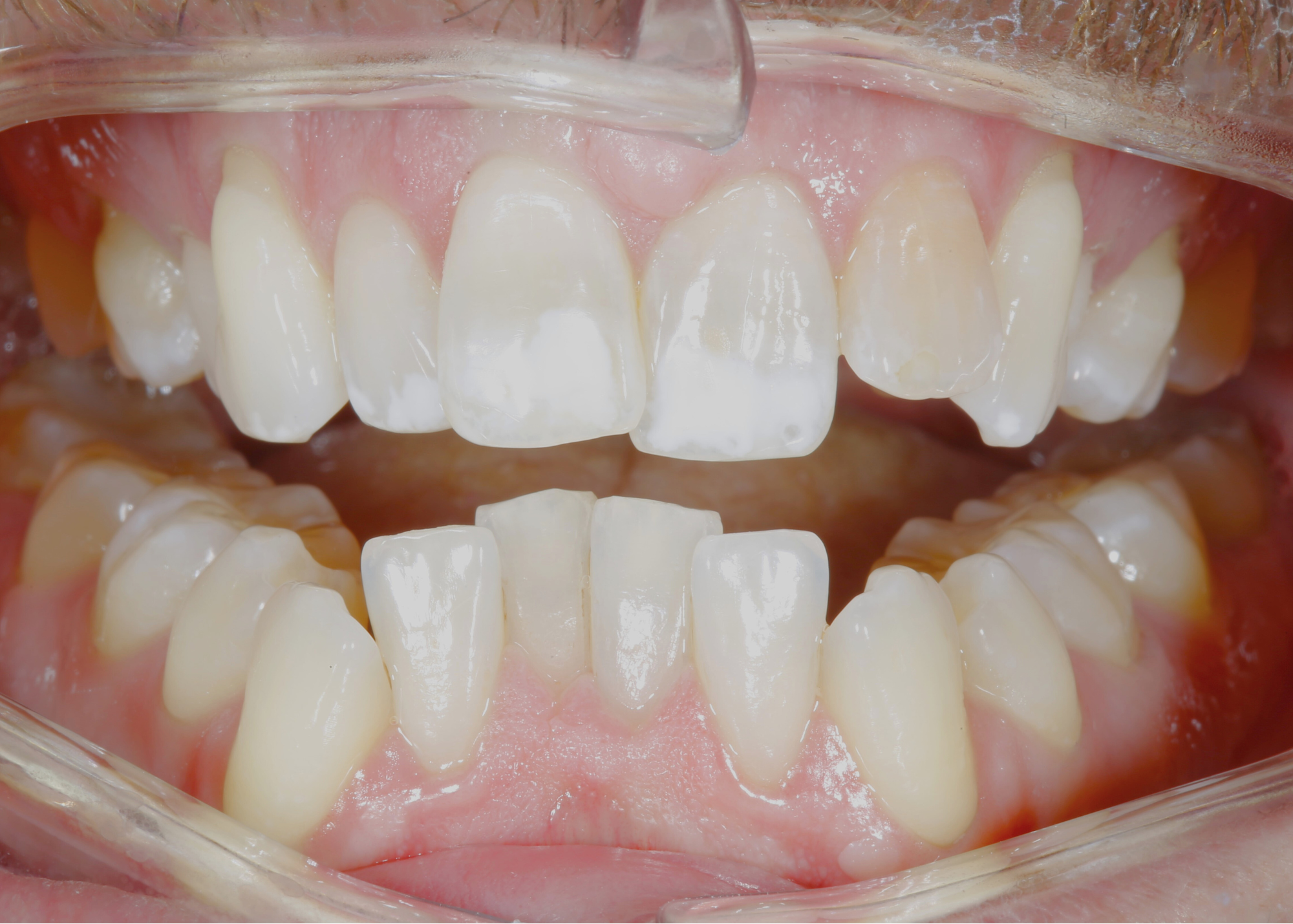Untitled design (42) Close-up image of a human mouth with slightly parted lips, showing teeth with visible white spots. The gums appear healthy and pink.