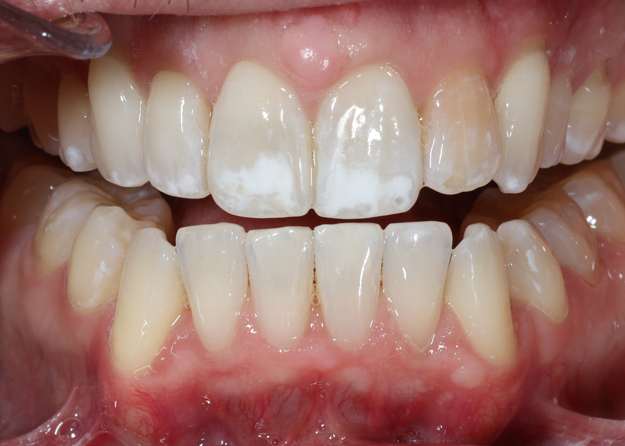 Close-up of teeth featuring white spots on upper front teeth and uneven color. Gums appear healthy. The image conveys a dental condition.